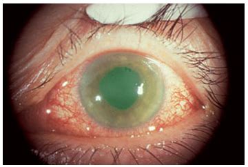 Angle closure glaucoma is sometimes iatrogenic. Pediatric Glaucoma