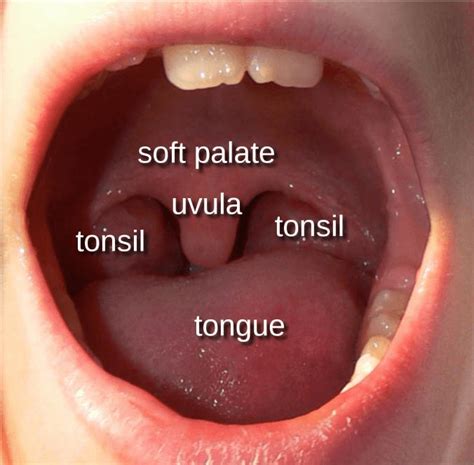 What Are Tonsils And Adenoids Ent 4 Kids