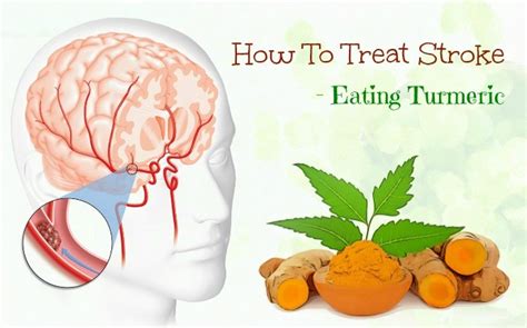 29 Remedies On How To Treat Stroke Naturally At Home 2023