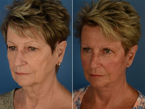 The Uplift™ Lower Face And Neck Lift Photos Naples Fl Patient 14461