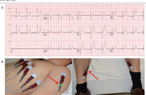 Figure 5 From Common Ecg Lead Placement Errors Part I