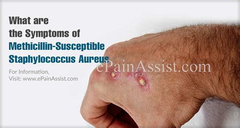 What Is Methicillin Susceptible Staphylococcus Aureus Mssa Causes