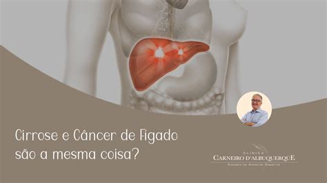 Cirrose e Câncer de Fígado são a mesma coisa Prof Dr Luiz Carneiro