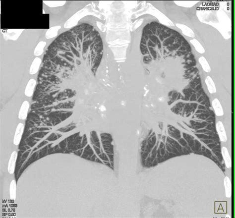 Sarcoidosis With Nodules Chest Case Studies Ctisus Ct Scanning