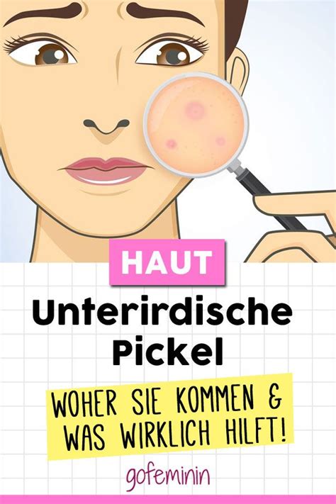 Ich mache mir auch jeden abend zinksalbe auf die stellen und sie sind schon heller, aber wie lange dauert es bis sie ganz verschwinden? Unterirdische Pickel: Das hilft gegen die fiesen Knubbel ...