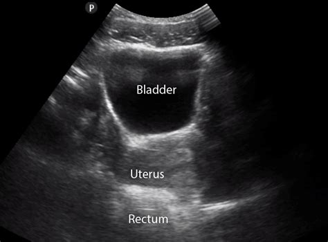 pocus is the fastest way to assess your patient s bladder 1⃣learn how to perform bladder