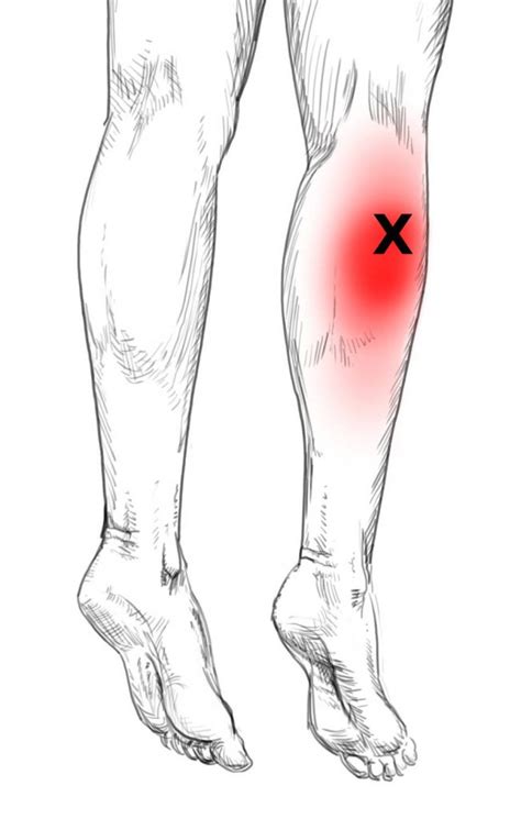 Gastrocnemius Pain And Trigger Points