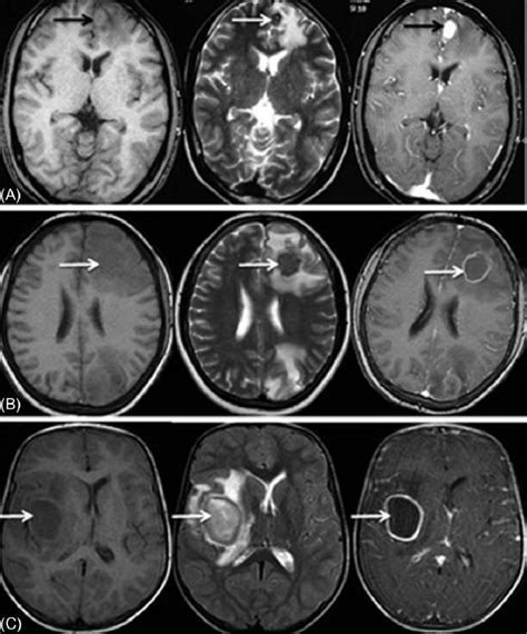 Staging Of Tuberculoma Noncaseating Caseating And Liquificated