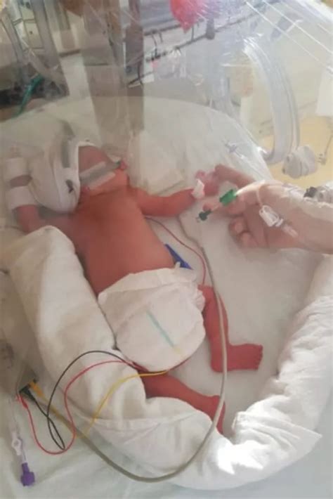 miracle twins defy 5 survival odds thanks to life saving op inside the womb daily record