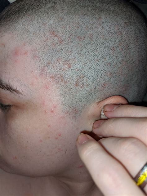 Need Help With Scalp Pimple Pics General Acne Discussion