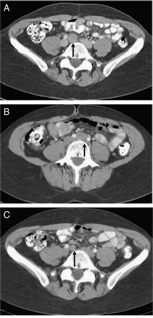 A Axial Contrast Enhanced Ct Image Demonstrating An Enlarged Lymph