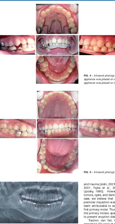 Figure 1 From Orthodontic Treatment Of A Unilateral Impacted Mandibular