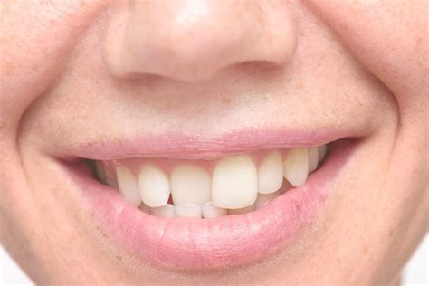 Treating Crooked Teeth In Adulthood Annapolis Md Dentist
