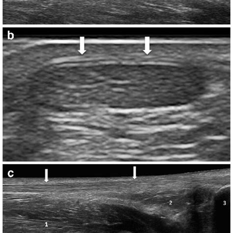 Achilles Tendon After Surgery Longitudinal A And Axial B Scans