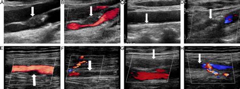 Ultrasonography Of The Carotid And Lower Limb Arteries Of A Year Old