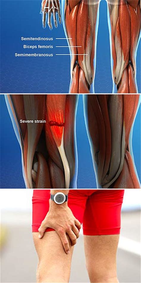 Hamstring Muscle Injuries Central Coast Orthopedic Medical Group