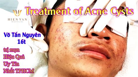 Stupid Love With Acne Removal 116 Loan Nguyen Pimple Popping Videos