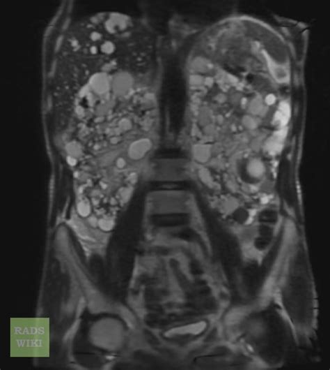 Polycystic Kidney Disease Mri Radrounds Radiology Network