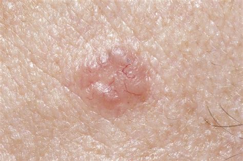 Skin Cancer Basal Cell Carcinoma Stock Image M1310742 Science