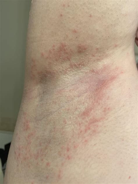 Rash On Thigh Is This Chickenpox Its Not Itchy But Its Spreading