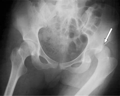 Anterior Vs Posterior Hip Dislocation