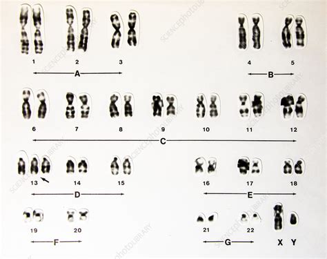 Human Male Karyotype Trisomy 13 Stock Image C0503982 Science Photo Library