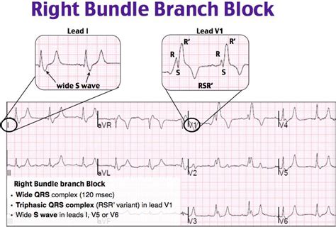 Right Bundle Branch Block Rosh Review Cardiac Nursing Bundle Branch