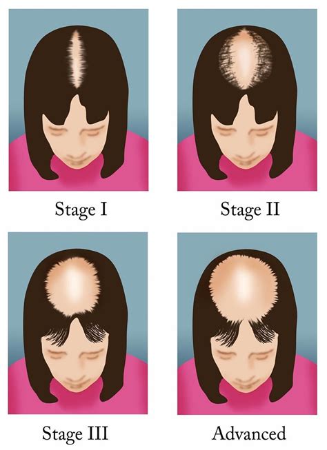 Female Pattern Baldness Female Pattern Baldness Pattern Baldness