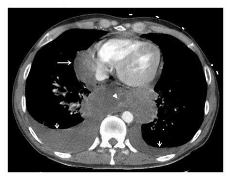 Contrast Enhanced Ct Scan Of The Thorax A Lung Window Confirming
