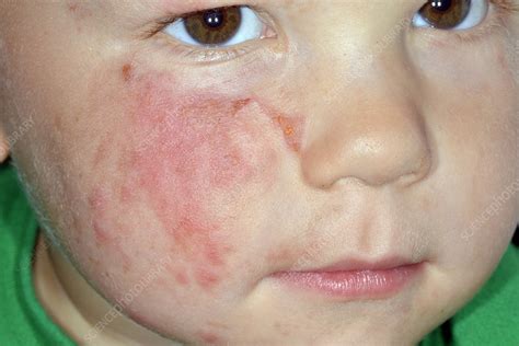 Cellulitis Of The Face Stock Image C0263286 Science Photo Library