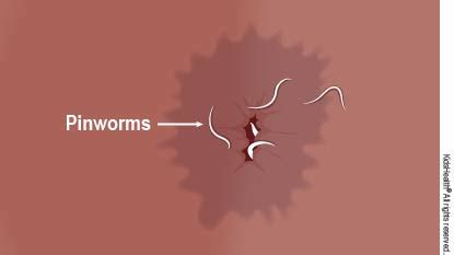 Diagram Showing Pinworms Around The Anus Suara Insan