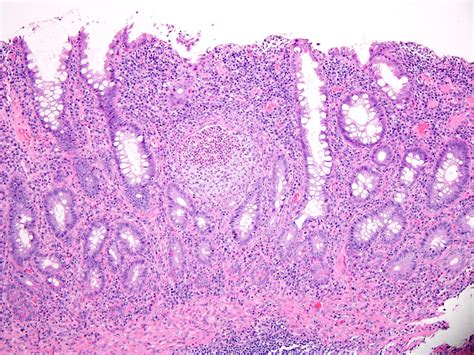 Pathology Outlines Ulcerative Colitis