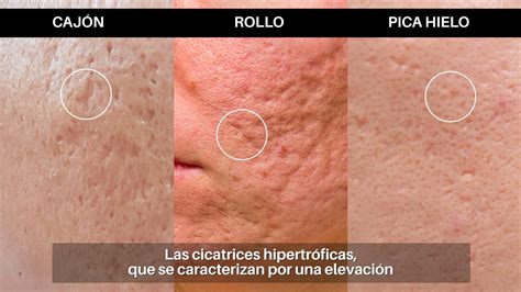 Tipos De Cicatrices De Acné Clínica Dermatológica Ollague Youtube