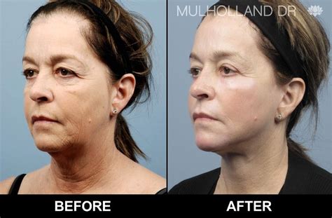 Before And After Photos Of Toronto Patients Who Have Underwent A Face