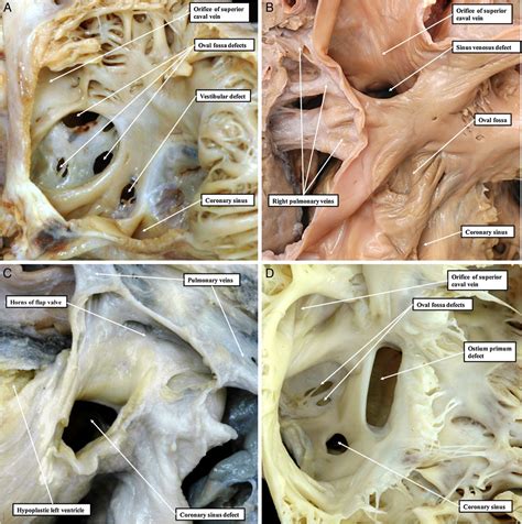 Development of the atrial septum in relation to postnatal anatomy and