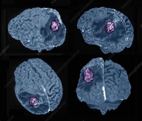 Recurrent Glioma Brain Tumour 3d Mri Scans Stock Image C0474840