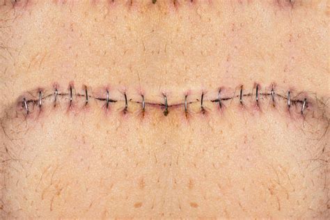 Medical Stitches Pictures Images And Stock Photos Istock