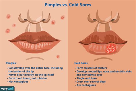 Is It A Cold Sore Or Pimple