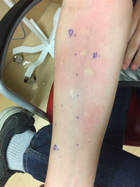 Skin Scratch Tests And Mcas The Walking Allergy
