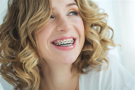 A Guide To Adult Braces
