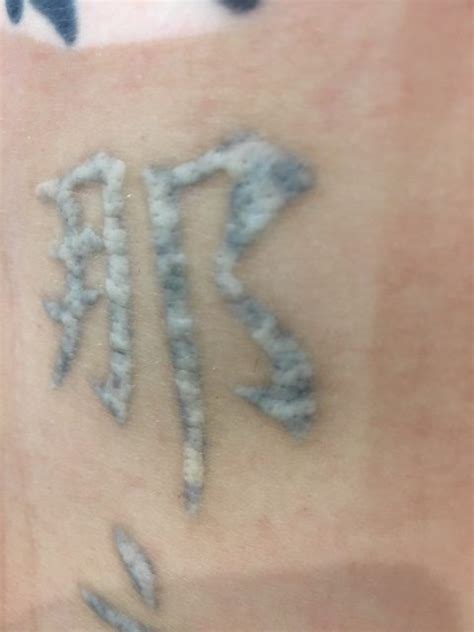 Tattoo Removal Gone Wrong How To Avoid A Tattoo Removal Disaster