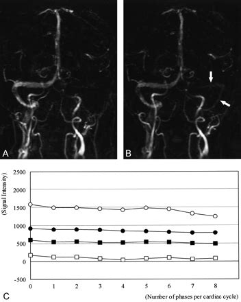 Physiologic Change In Flow Velocity And Direction Of Dural Venous