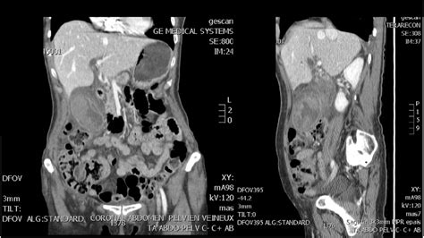 Coronal And Sagittal Enhanced Ct Images Showing A Markedly Distended