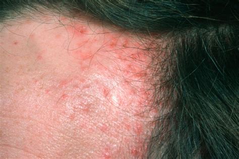 Derm Dx A 32 Year Old Man With Multiple Itchy Malodorous Papules