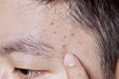 Folliculitis Causes Symptoms Treatment