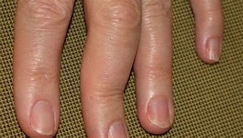 Psoriatic Arthritis In The Hands Symptoms Pictures And Treatment