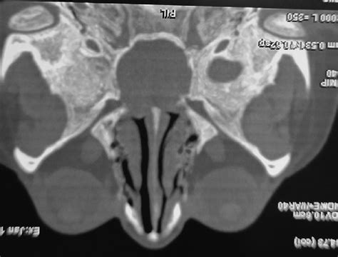 Computed Tomography Scan Of The Paranasal Sinus Axial Cut Showing A