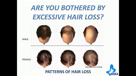 With that in mind, i've dedicated an entire article to this very topic. HAIR LOSS IS COMPLETELY REVERSIBLE WITHOUT SURGERY - YouTube