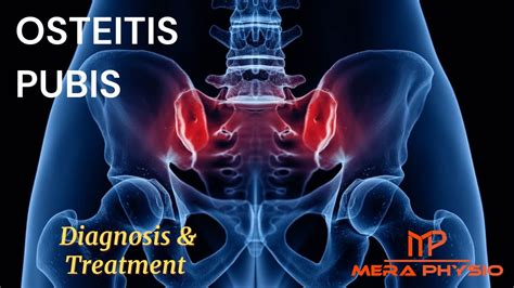 Osteitis Pubis Diagnosis Treatment In Hindi Mera Physio Youtube