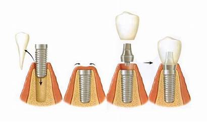 Dental Implant Procedure Implants Guide Surgery Tips
